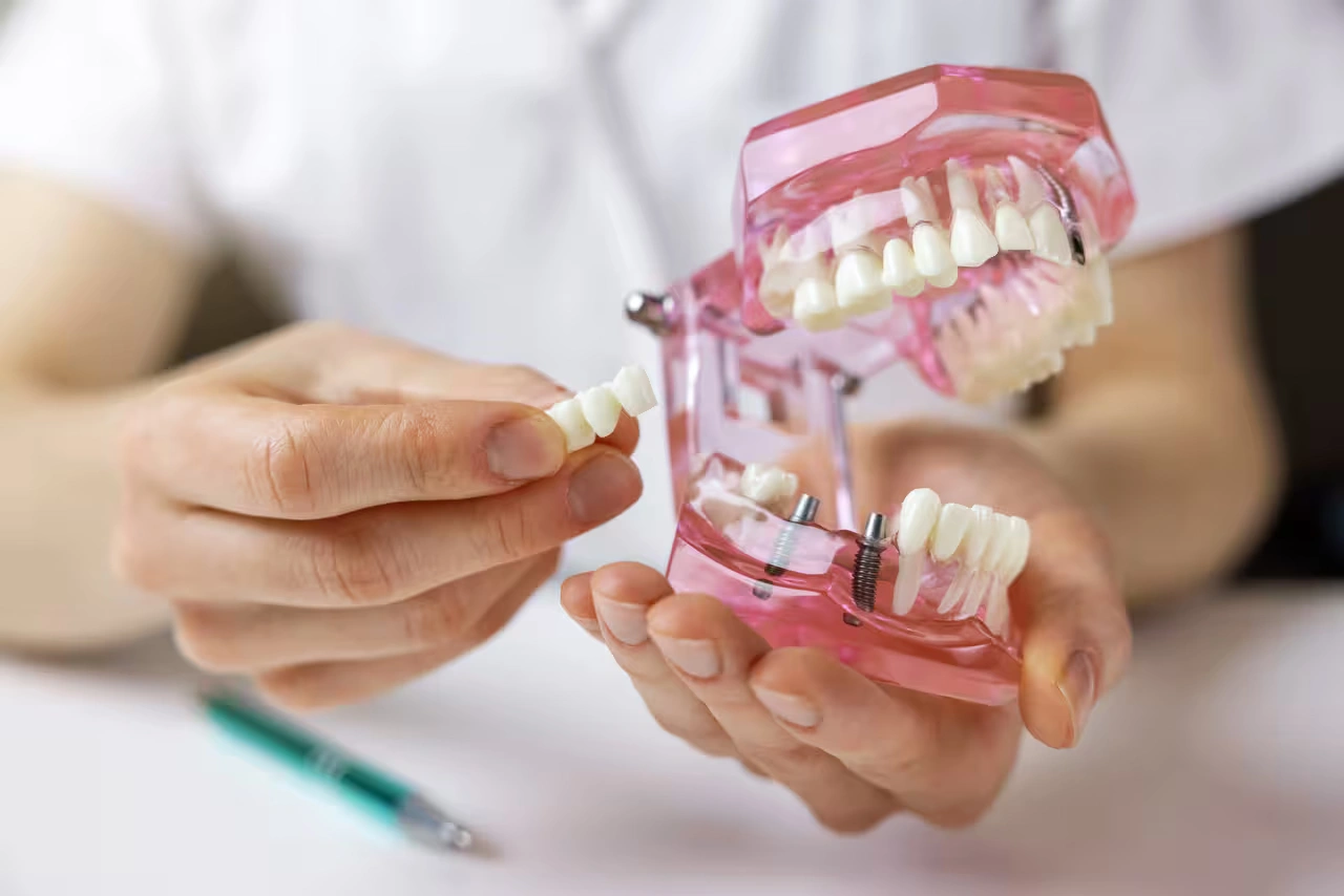 Dental Implants vs. Dental Bridges