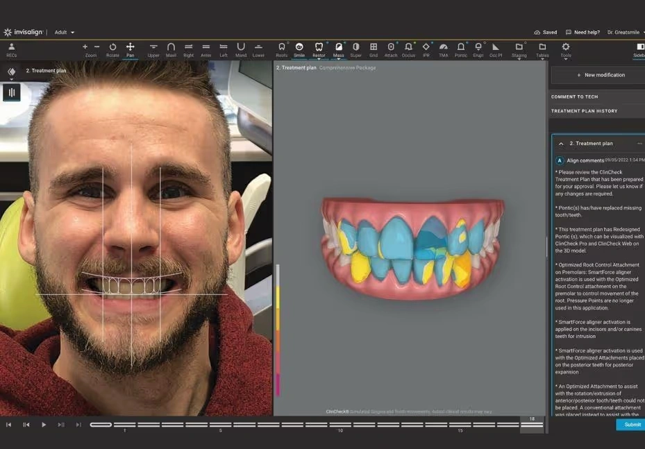 The Power of iTero Digital Scanning