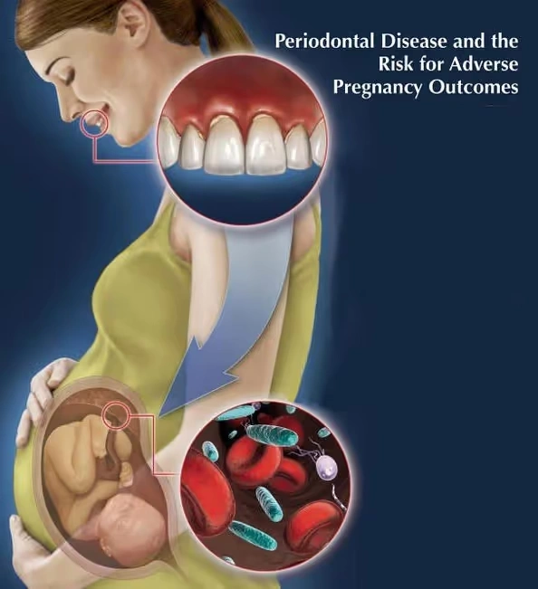 The Surprising Link Between Gum Disease and Fertility: What NYC Patients Should Know