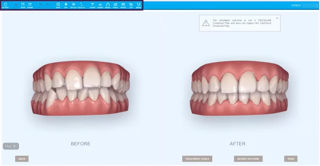 What to Expect During Your Invisalign Consultation