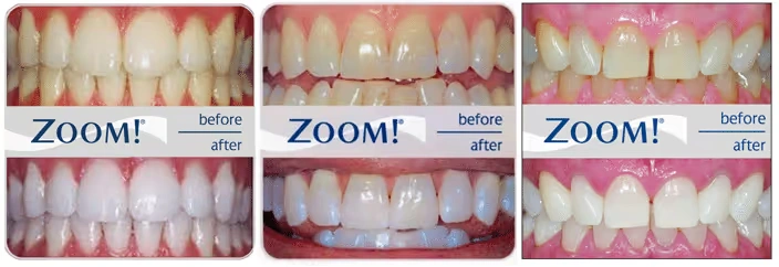 Instantly brighter smile