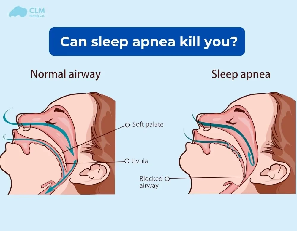 Can Sleep apnea kill you?