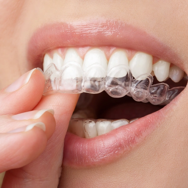 Close-up of ClearCorrect clear aligners on teeth