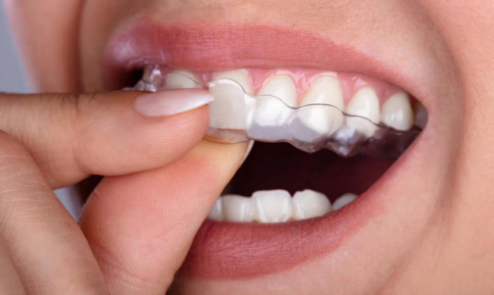 Person inserting ClearCorrect clear aligners over teeth