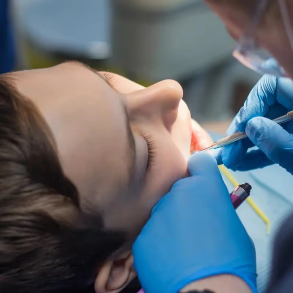 Dentist applying dental sealants to protect teeth from cavities