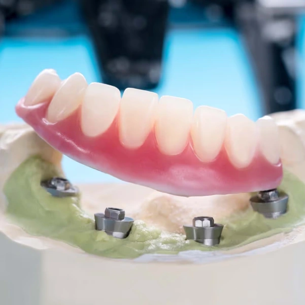 Implant-supported denture attached to multiple dental implants on a dental model