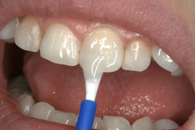 The Safe & Essential Secret to Cavity Prevention