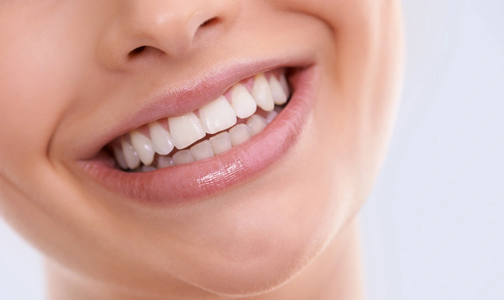 Close-up of a bright smile with Snap-On Smiles removable veneers