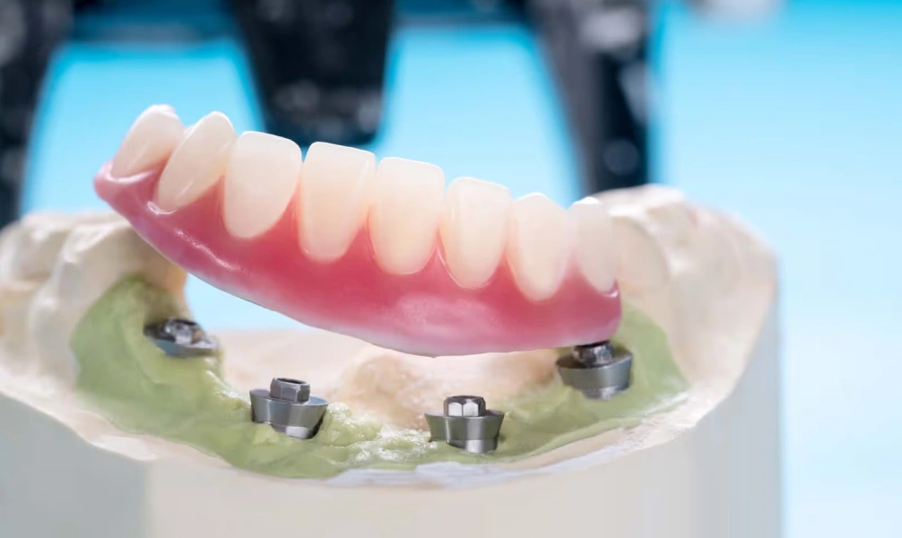 Implant-supported denture attached to multiple dental implants on a dental model