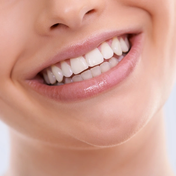 Close-up of a bright smile with Snap-On Smiles removable veneers