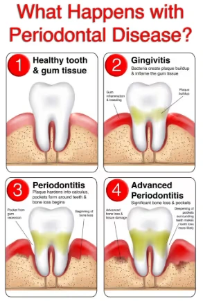 What Happens with Periodontal Disease?