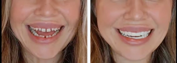 Before and after smile transformation showing restored teeth